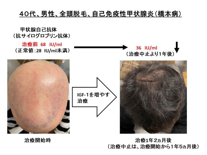 円形脱毛症　病院